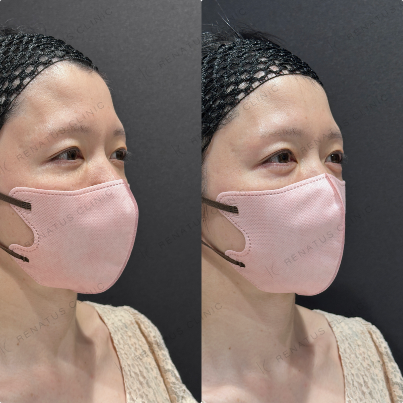 涙袋ヒアルロン酸ボルベラ症例写真