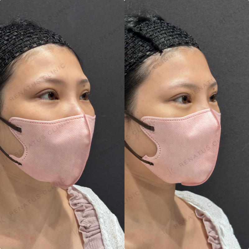 涙袋ヒアルロン酸ボルベラ症例写真