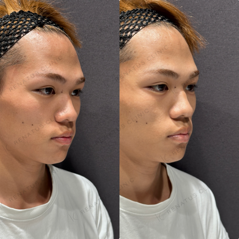 涙袋ヒアルロン酸ボルベラ症例写真