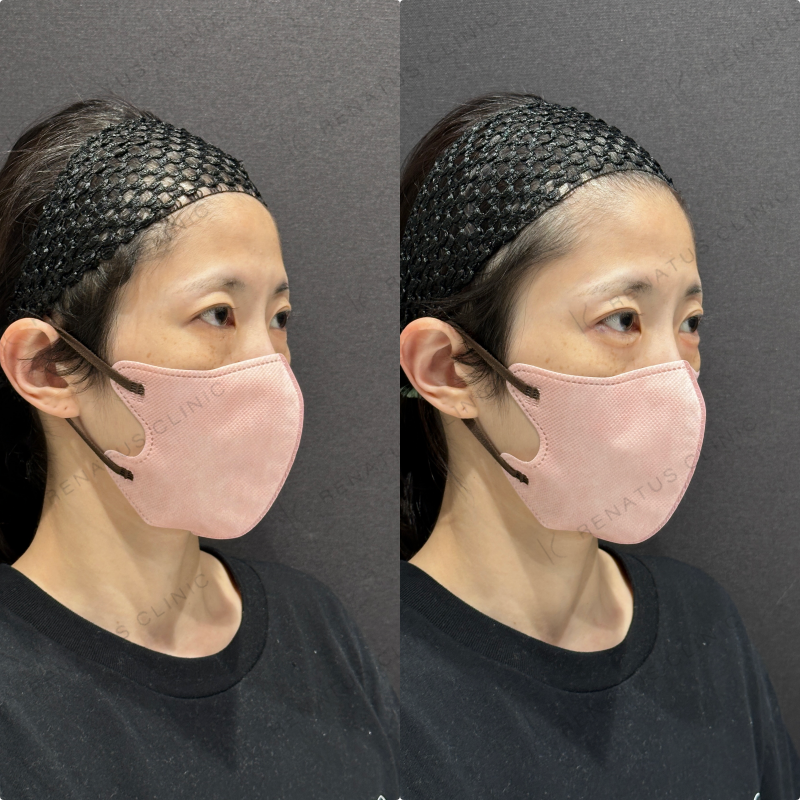 涙袋ヒアルロン酸ボルベラ症例写真