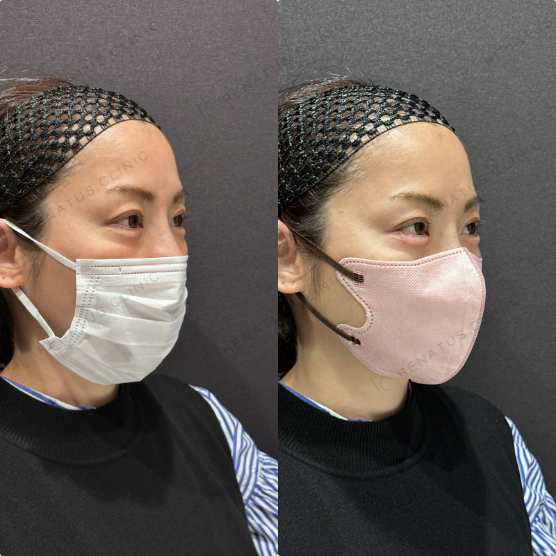 涙袋ヒアルロン酸ボルベラ症例写真