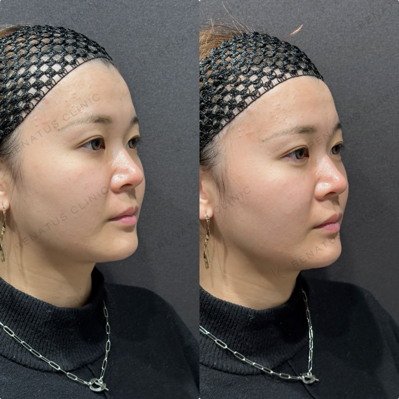 涙袋ヒアルロン酸ボルベラ症例写真