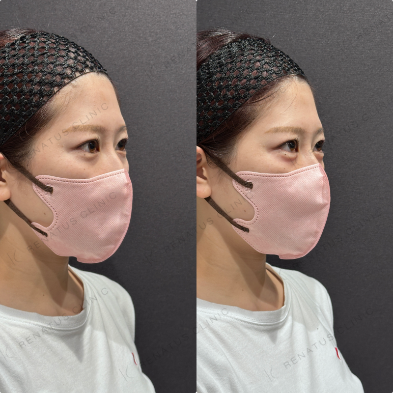 涙袋ヒアルロン酸ボルベラ症例写真