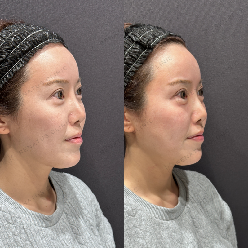 涙袋ヒアルロン酸ボルベラ症例写真