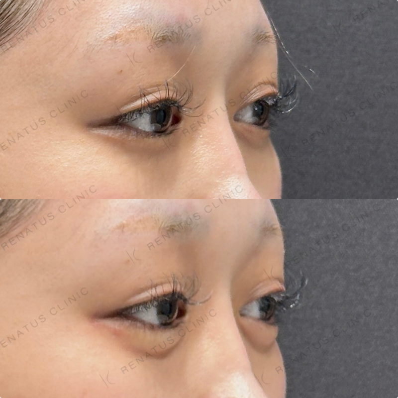 涙袋ヒアルロン酸ボルベラ症例写真