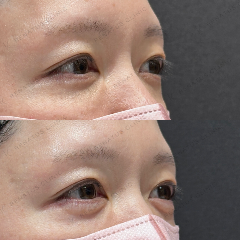 涙袋ヒアルロン酸ボルベラ症例写真