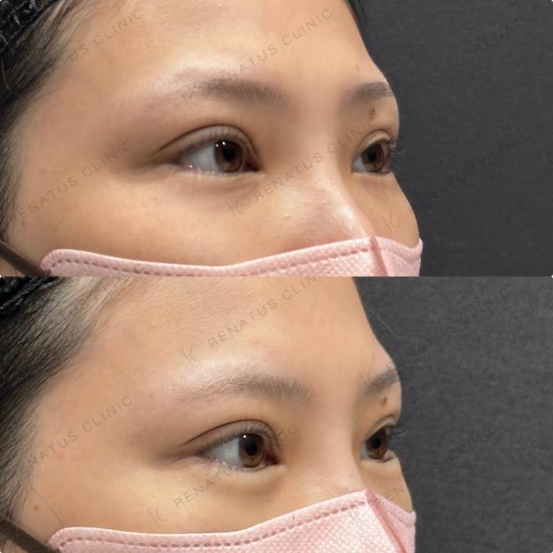 涙袋ヒアルロン酸ボルベラ症例写真