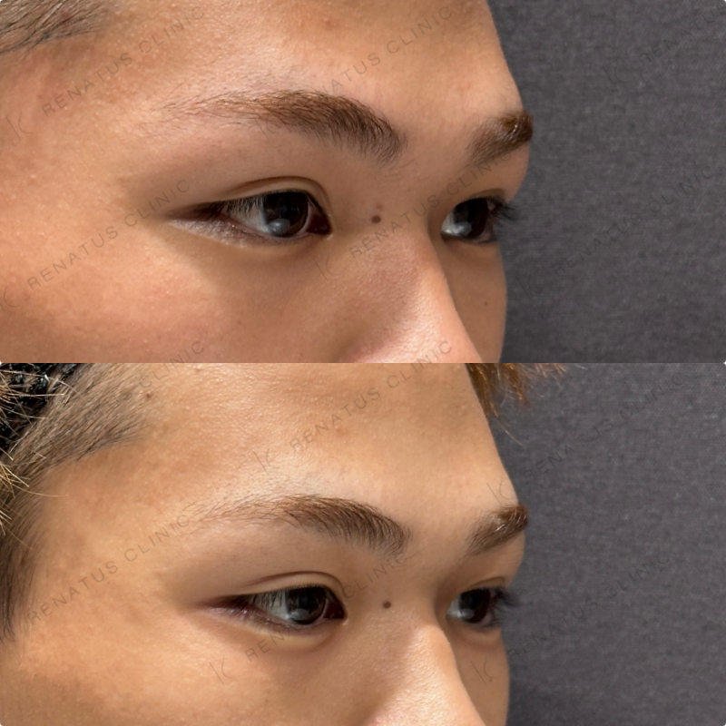 涙袋ヒアルロン酸ボルベラ症例写真