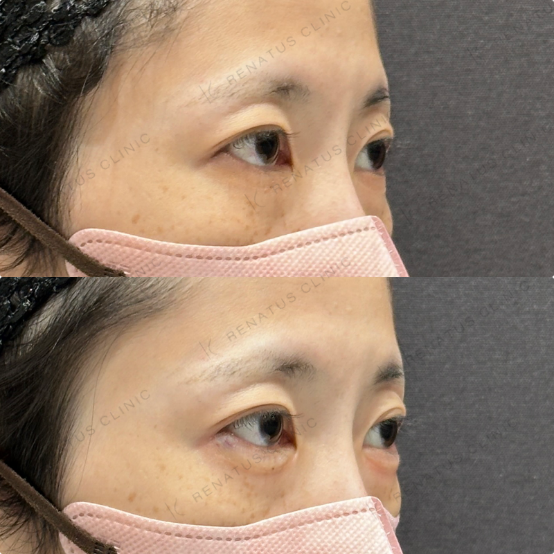 涙袋ヒアルロン酸ボルベラ症例写真