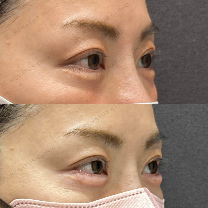 涙袋ヒアルロン酸ボルベラ症例写真