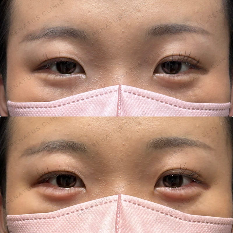 涙袋ヒアルロン酸ボルベラ症例写真