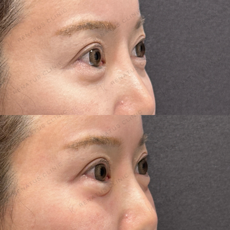 涙袋ヒアルロン酸ボルベラ症例写真