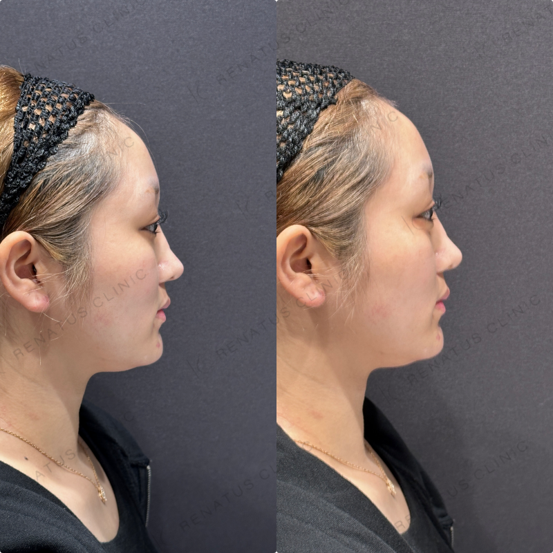 涙袋ヒアルロン酸ボルベラ症例写真