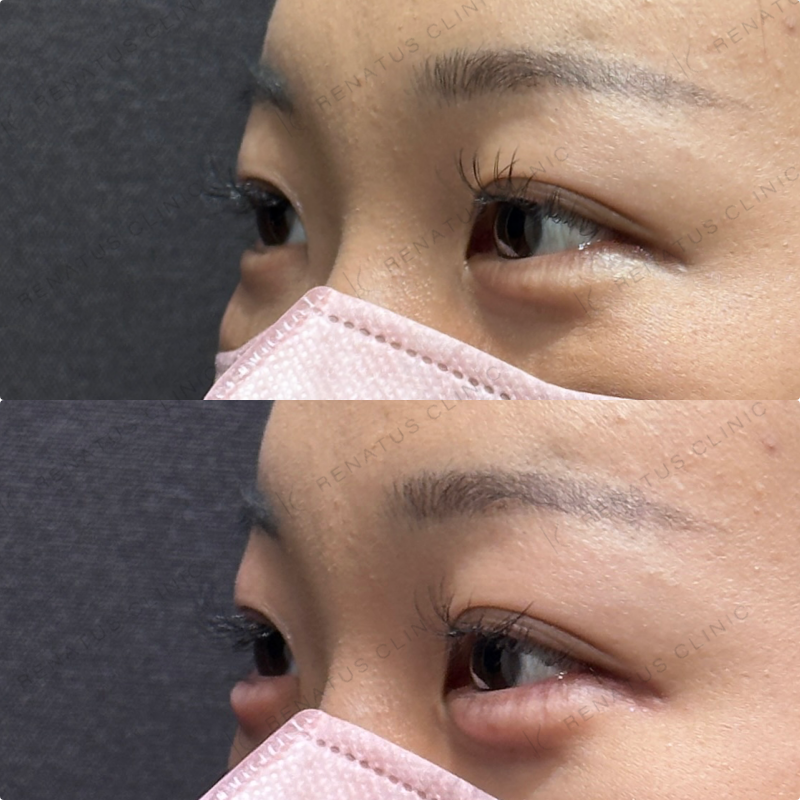 涙袋ヒアルロン酸ボルベラ症例写真