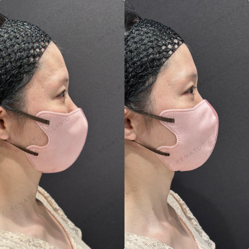 涙袋ヒアルロン酸ボルベラ症例写真