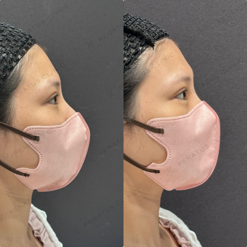 涙袋ヒアルロン酸ボルベラ症例写真