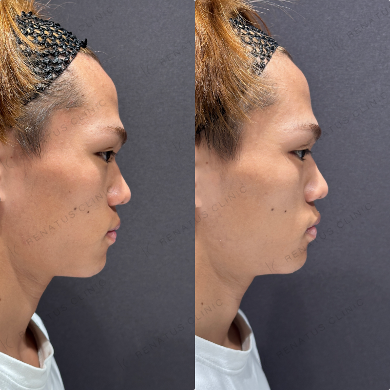 涙袋ヒアルロン酸ボルベラ症例写真