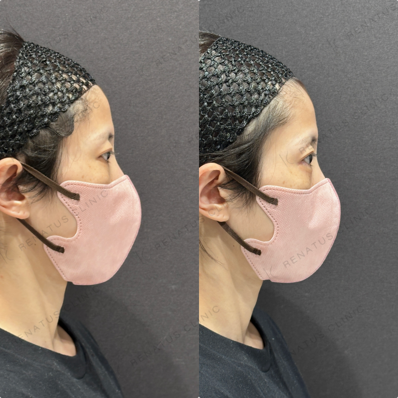 涙袋ヒアルロン酸ボルベラ症例写真