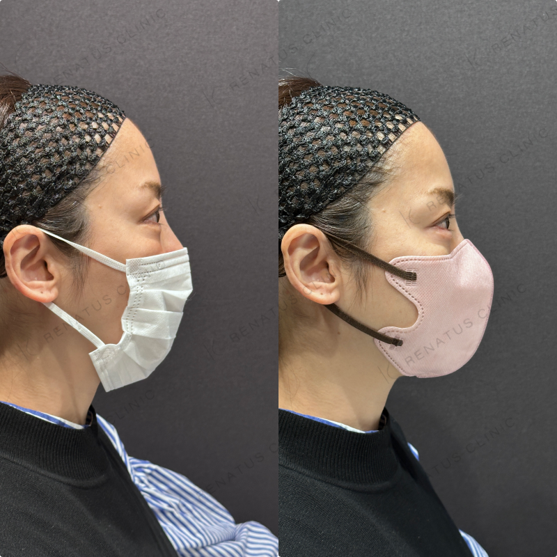 涙袋ヒアルロン酸ボルベラ症例写真