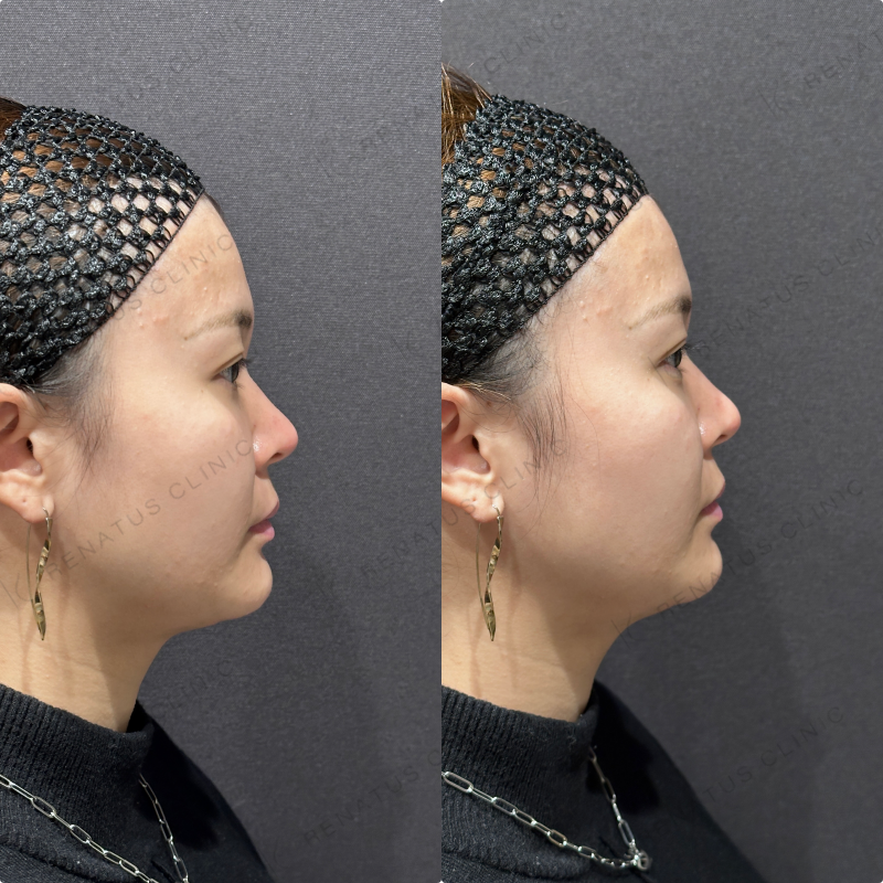 涙袋ヒアルロン酸ボルベラ症例写真