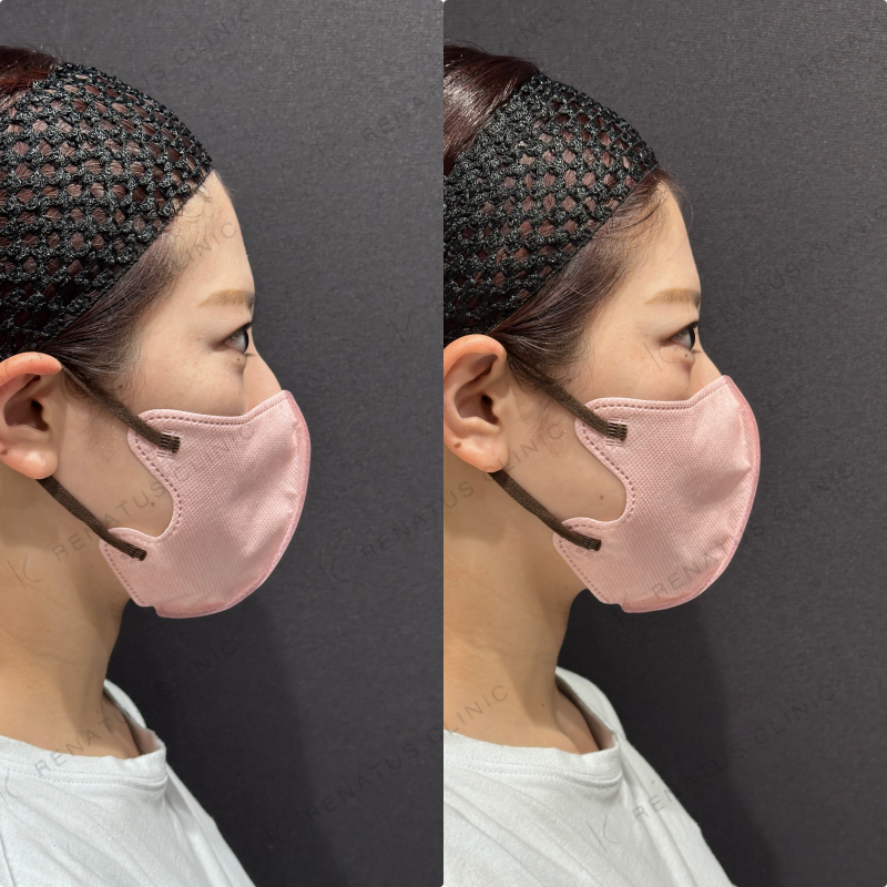 涙袋ヒアルロン酸ボルベラ症例写真