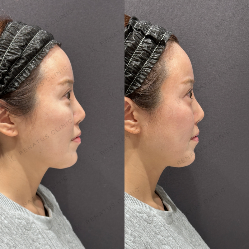 涙袋ヒアルロン酸ボルベラ症例写真