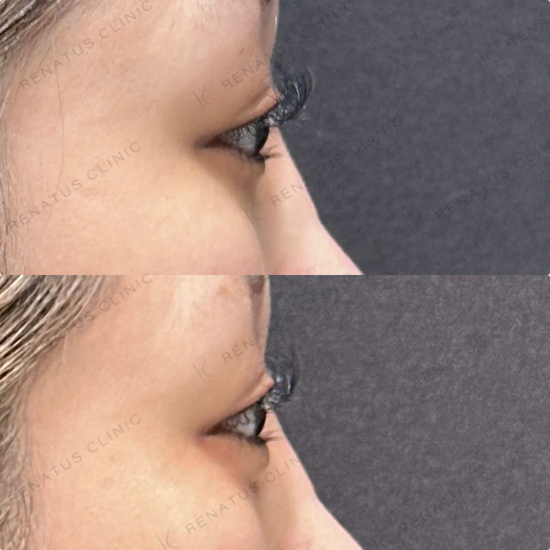 涙袋ヒアルロン酸ボルベラ症例写真