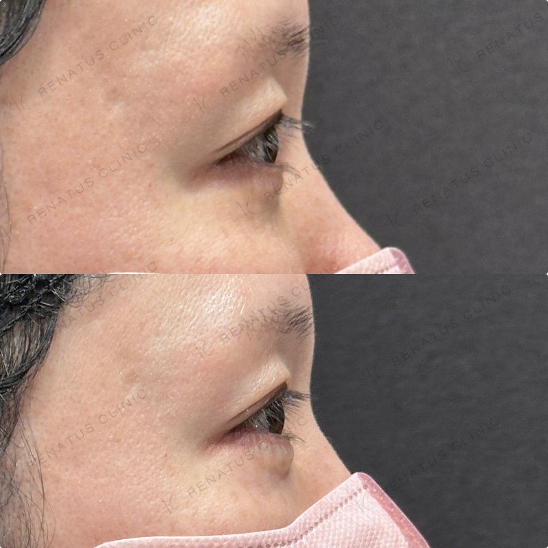 涙袋ヒアルロン酸ボルベラ症例写真