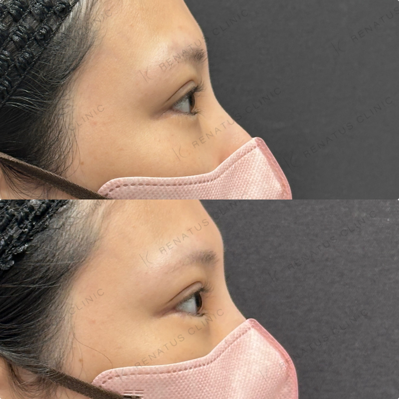 涙袋ヒアルロン酸ボルベラ症例写真