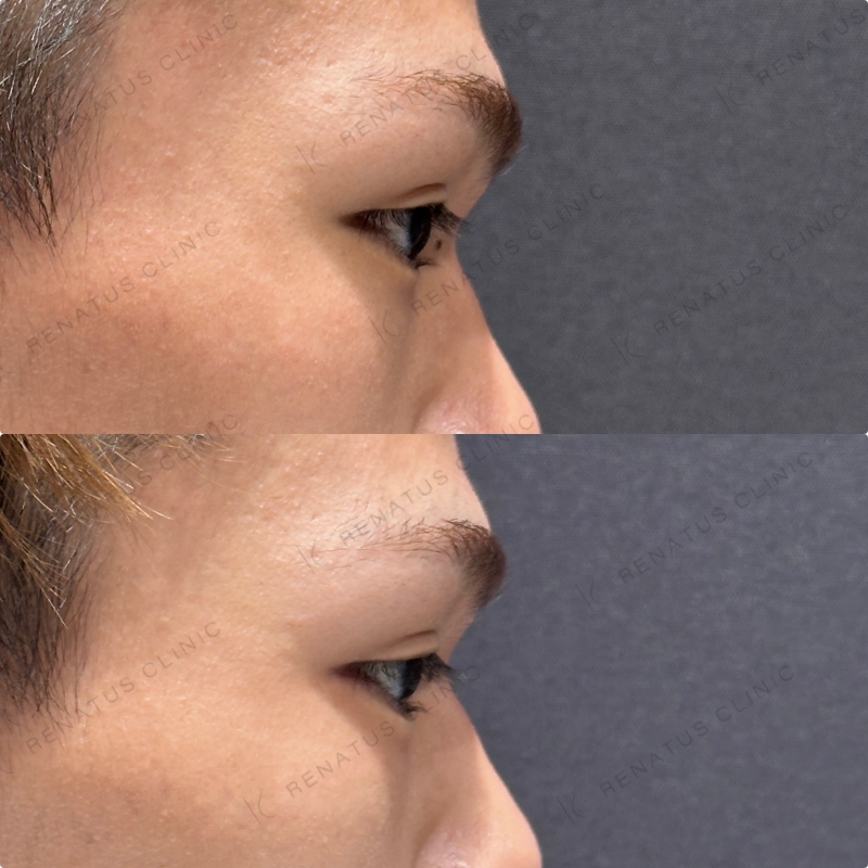 涙袋ヒアルロン酸ボルベラ症例写真