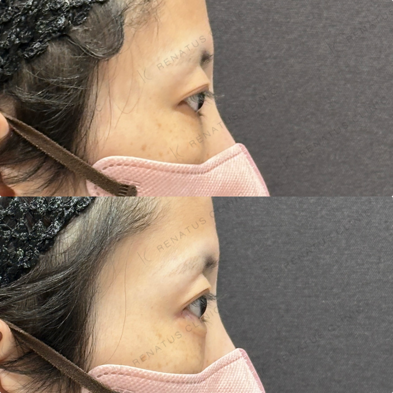 涙袋ヒアルロン酸ボルベラ症例写真