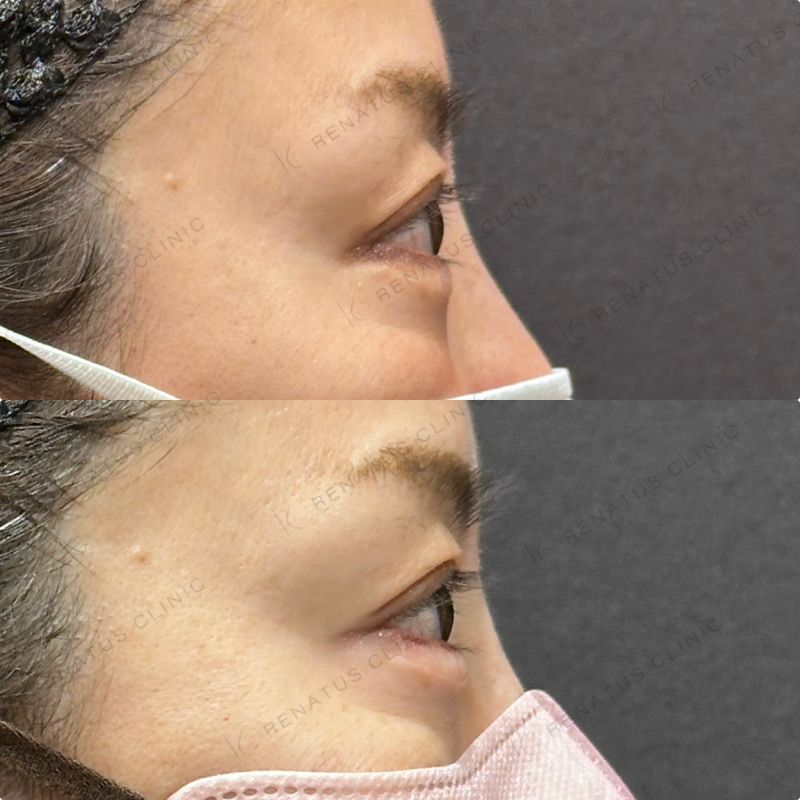 涙袋ヒアルロン酸ボルベラ症例写真