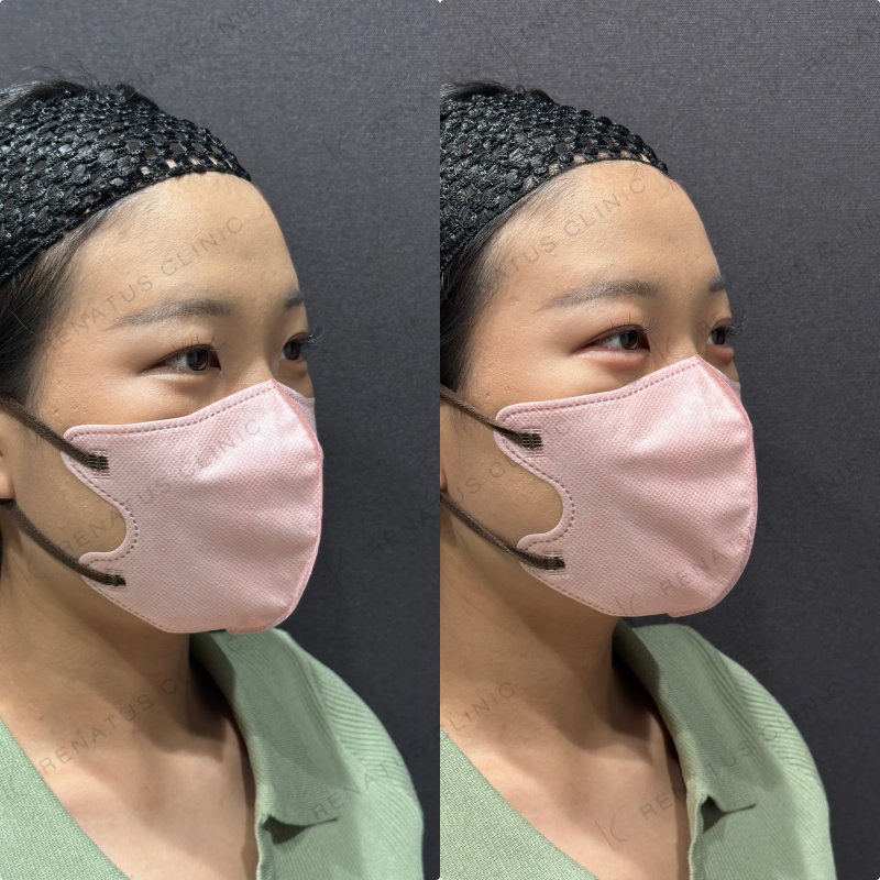 涙袋ヒアルロン酸ボルベラ症例写真