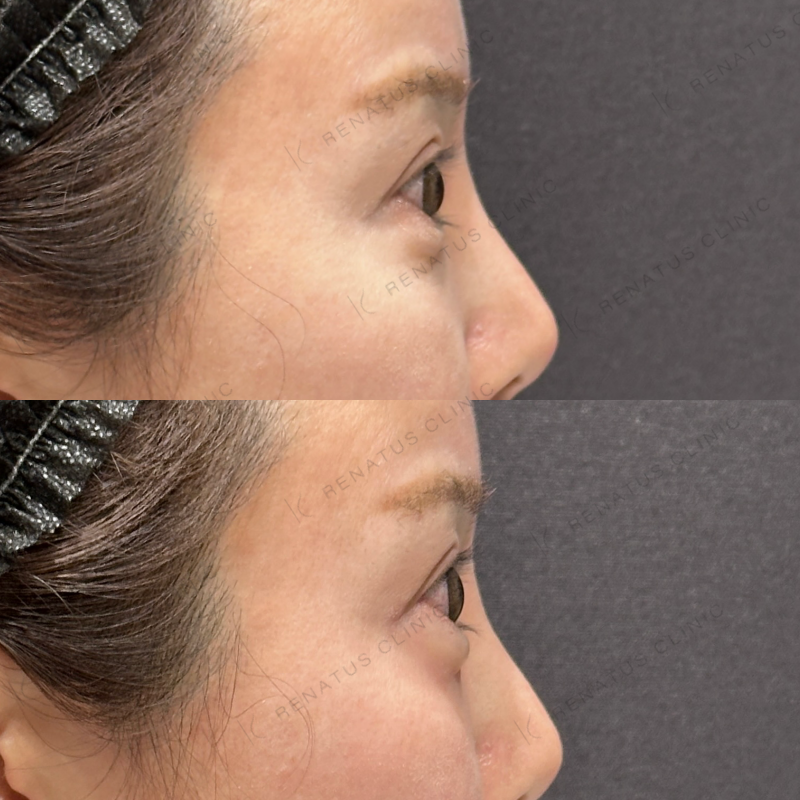 涙袋ヒアルロン酸ボルベラ症例写真