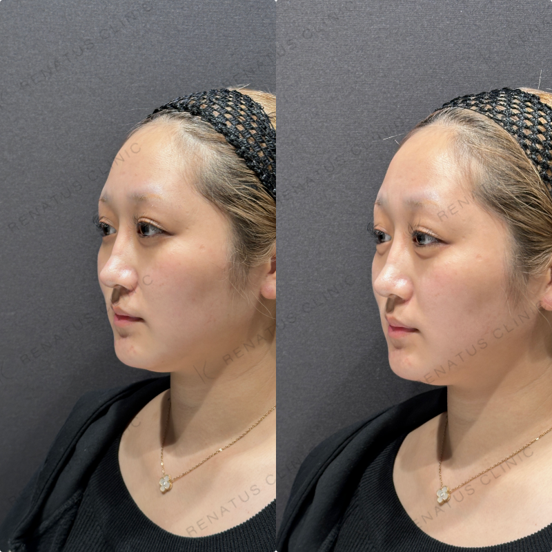 涙袋ヒアルロン酸ボルベラ症例写真