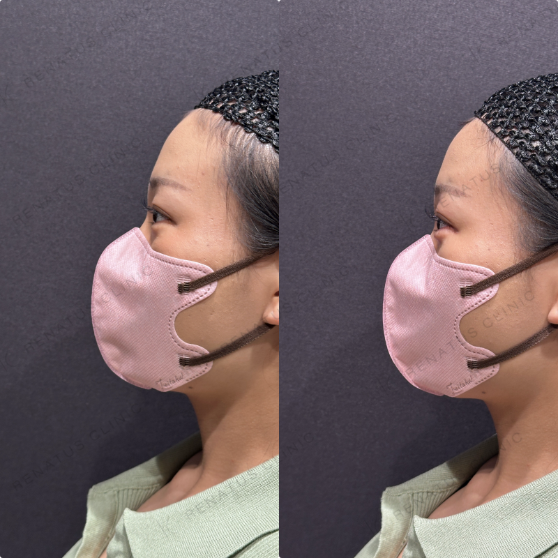 涙袋ヒアルロン酸ボルベラ症例写真