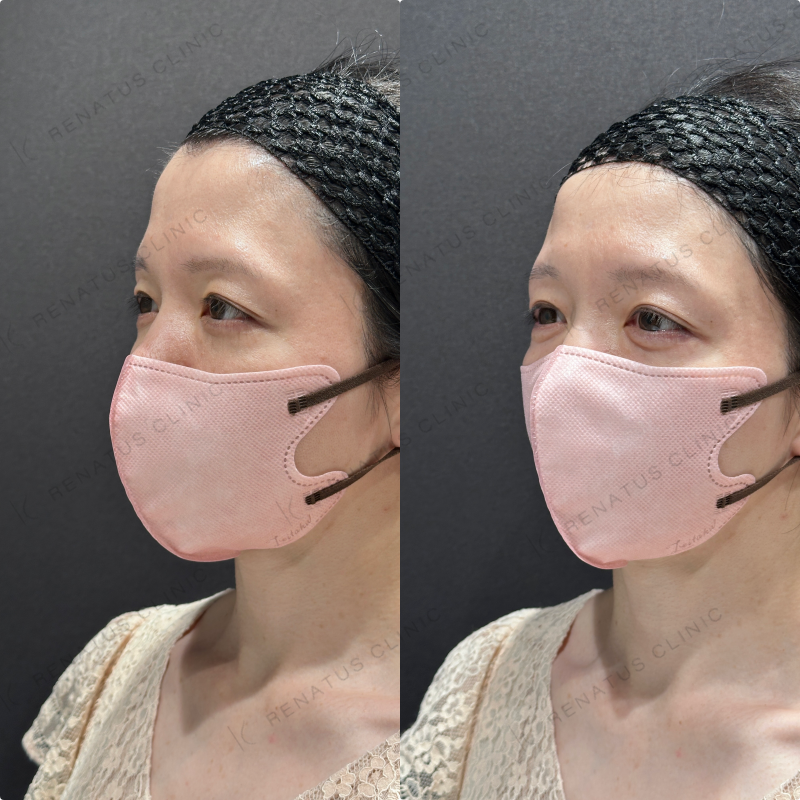 涙袋ヒアルロン酸ボルベラ症例写真