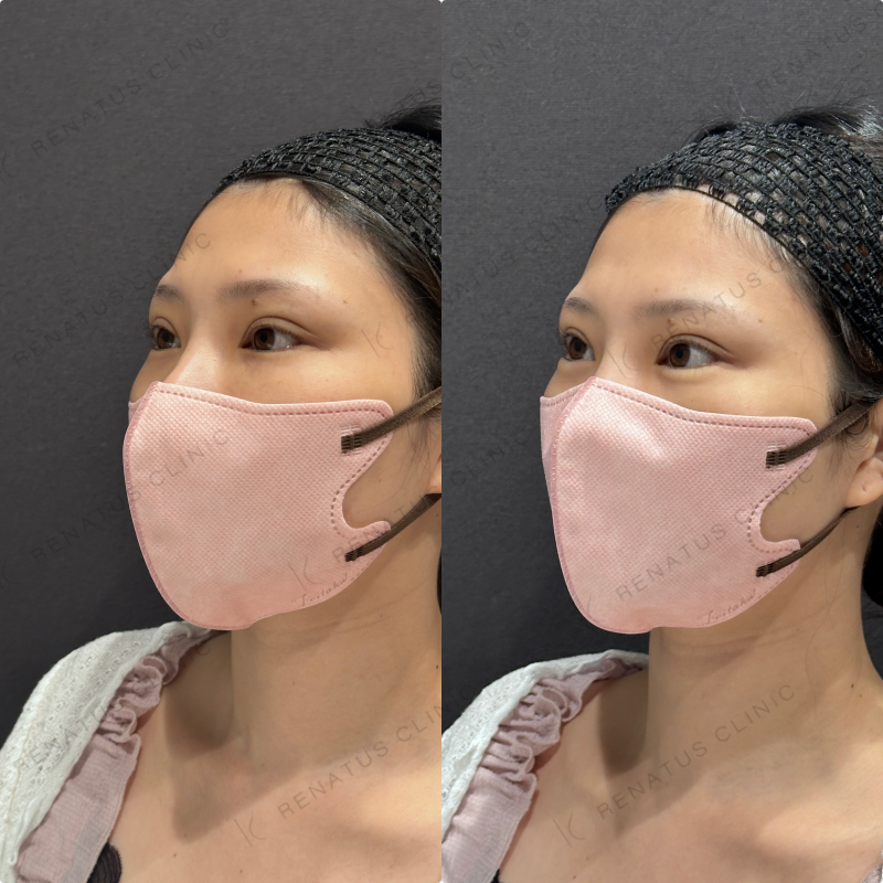 涙袋ヒアルロン酸ボルベラ症例写真