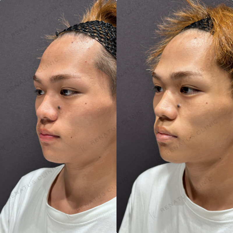 涙袋ヒアルロン酸ボルベラ症例写真