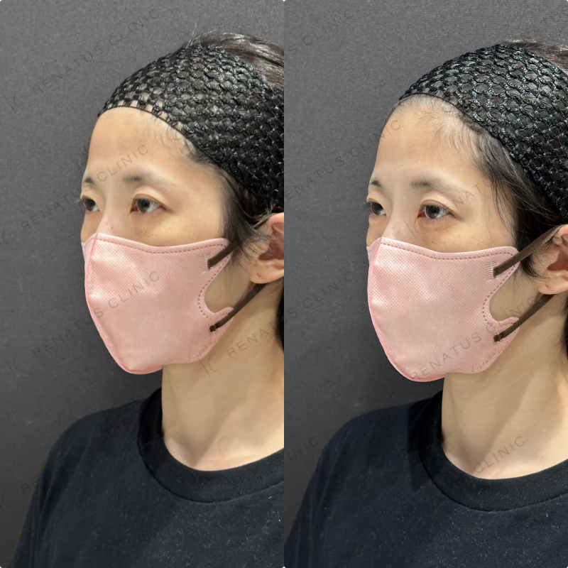 涙袋ヒアルロン酸ボルベラ症例写真