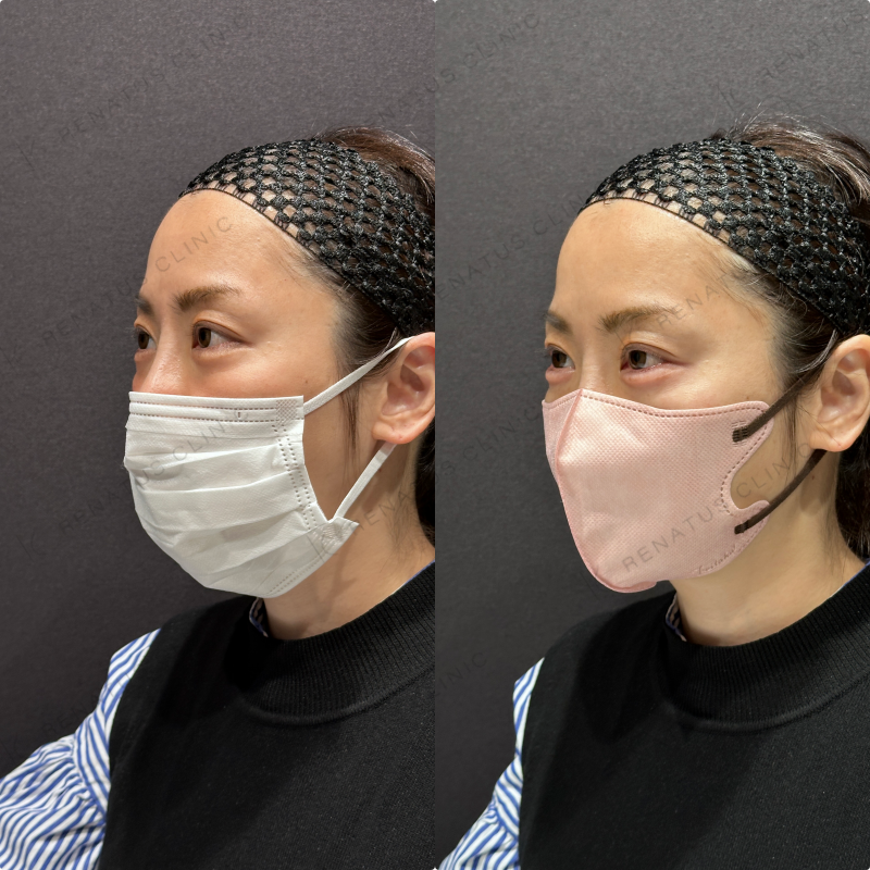 涙袋ヒアルロン酸ボルベラ症例写真