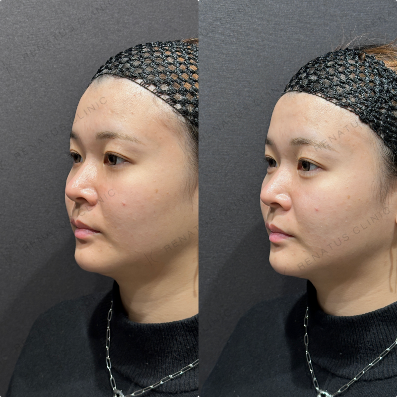 涙袋ヒアルロン酸ボルベラ症例写真