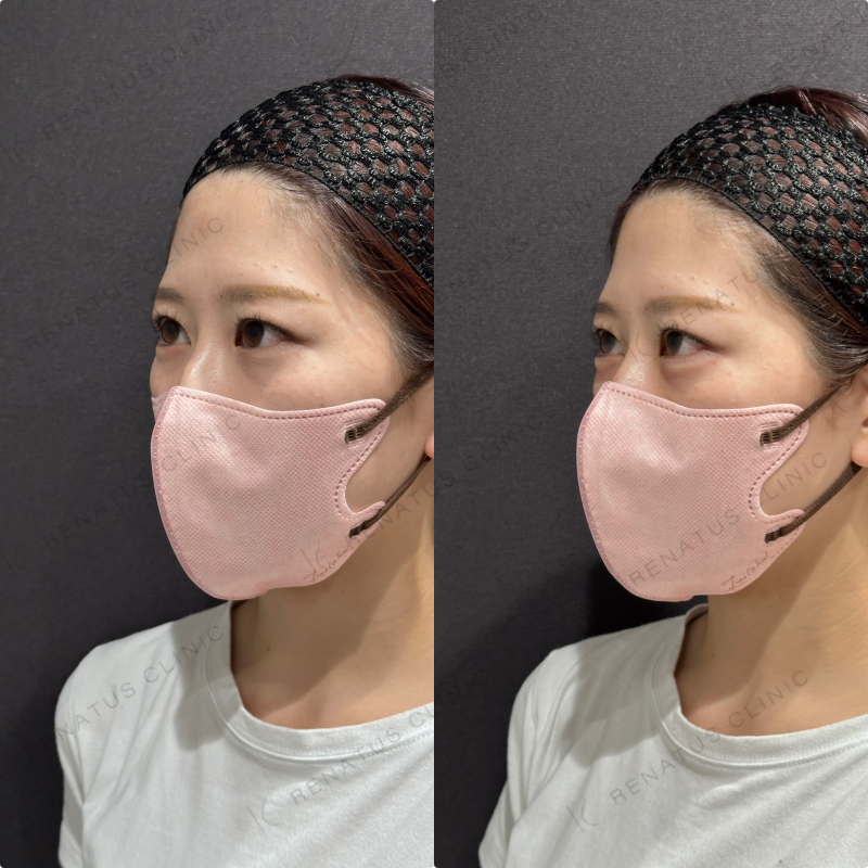 涙袋ヒアルロン酸ボルベラ症例写真