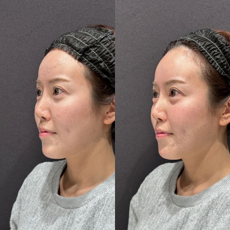 涙袋ヒアルロン酸ボルベラ症例写真