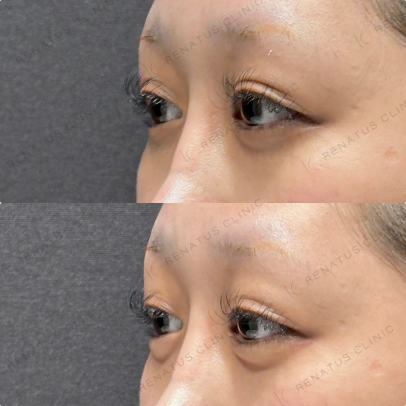 涙袋ヒアルロン酸ボルベラ症例写真