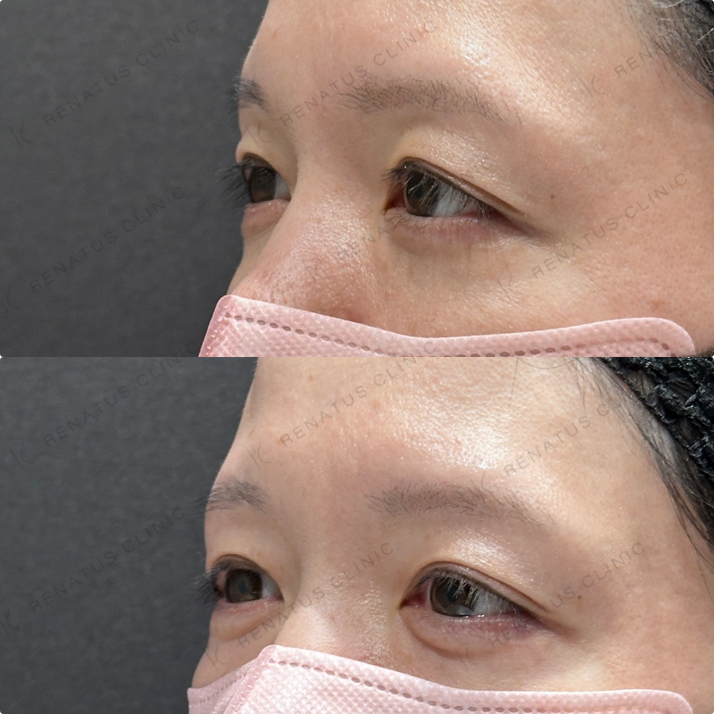 涙袋ヒアルロン酸ボルベラ症例写真