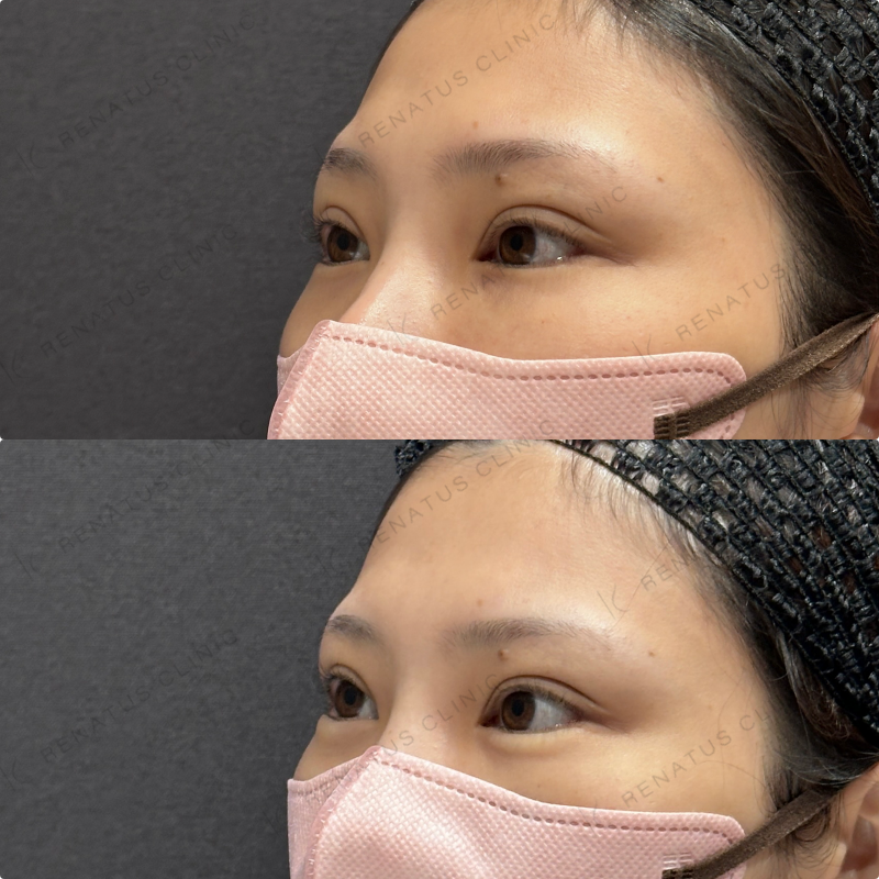 涙袋ヒアルロン酸ボルベラ症例写真