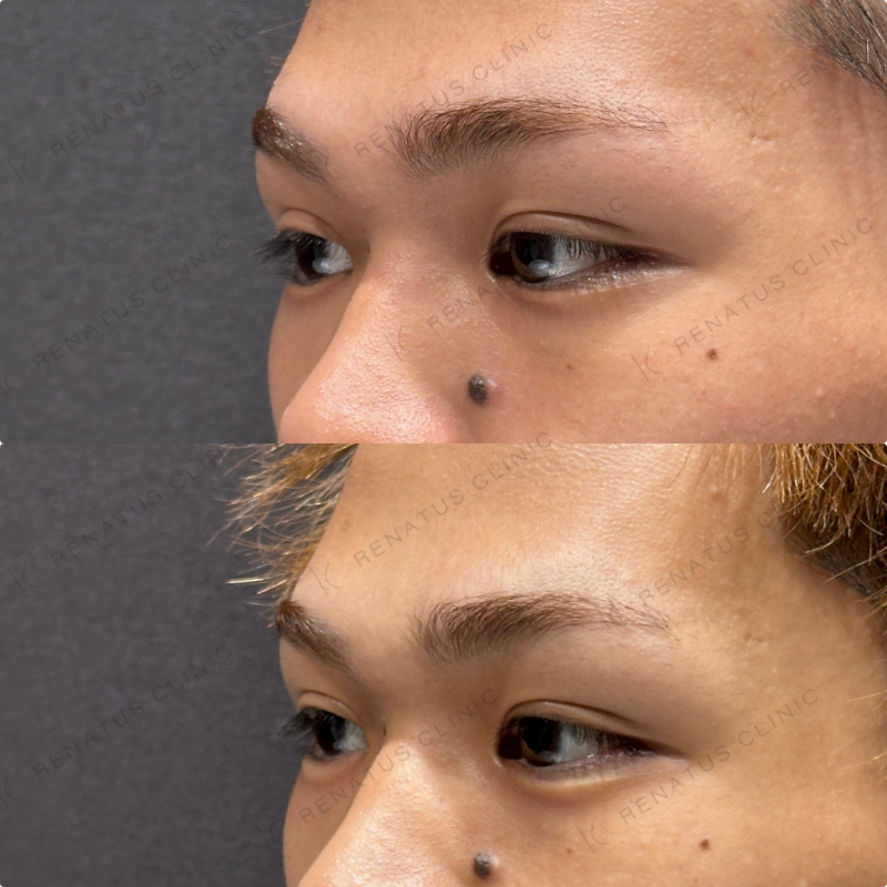 涙袋ヒアルロン酸ボルベラ症例写真