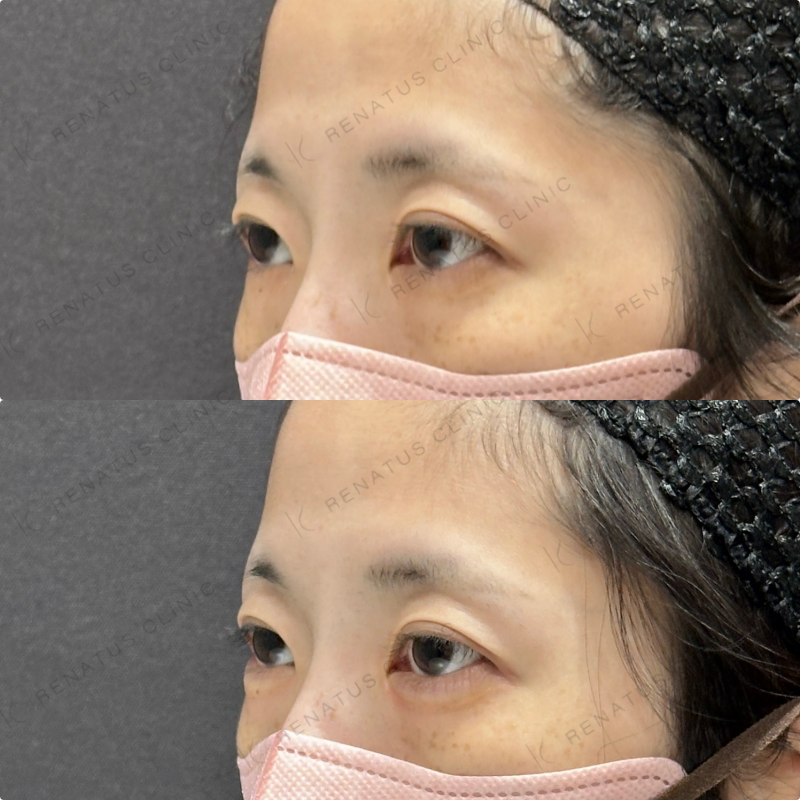 涙袋ヒアルロン酸ボルベラ症例写真