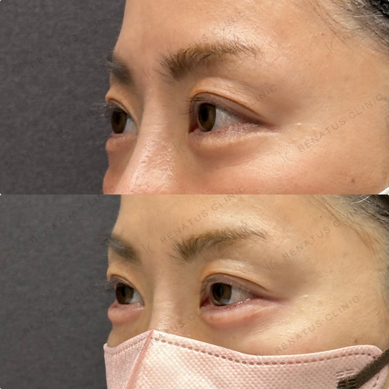 涙袋ヒアルロン酸ボルベラ症例写真